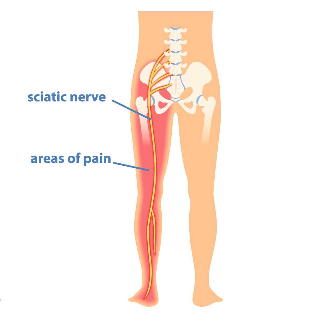 What is Sciatica? - Twin Cities Pain Clinic