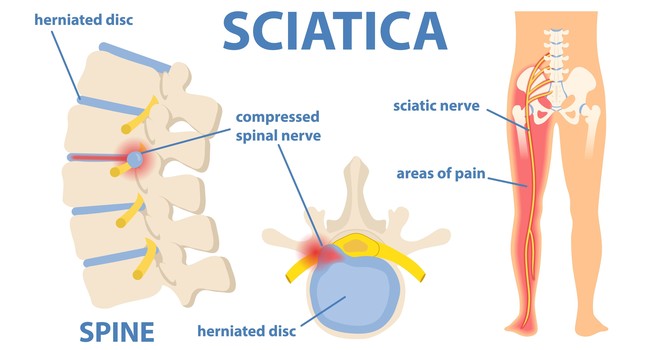 Finding Sciatic Nerve Pain Relief in Rochester, MN