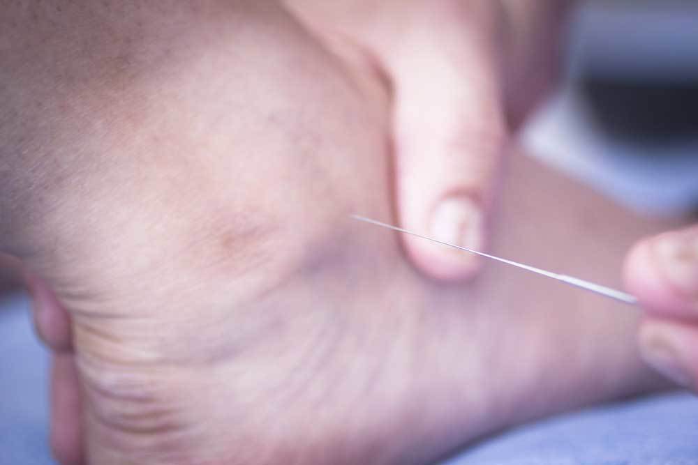 dry needle