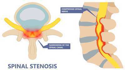 spinal stenosis